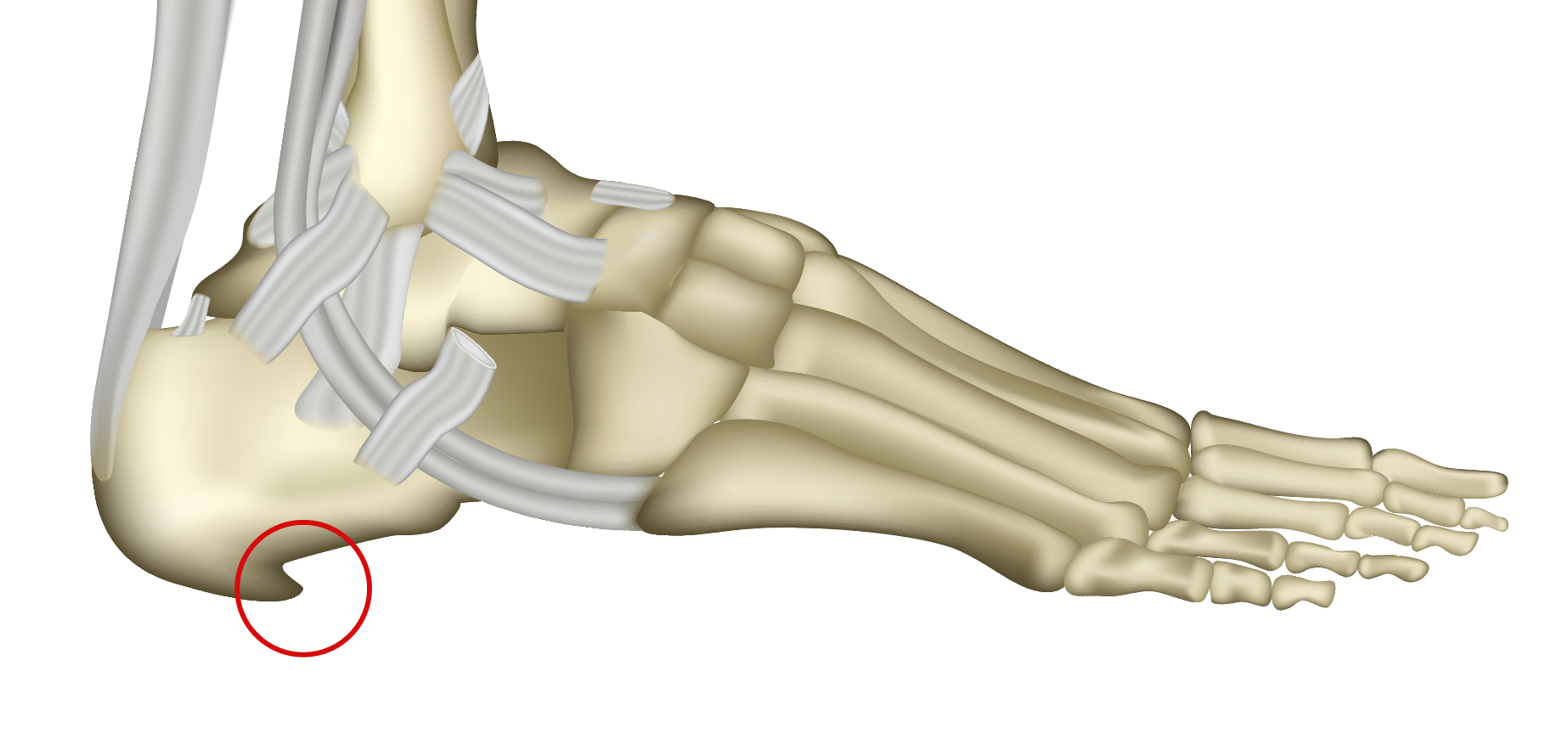 Fersensporn (Plantarfasziitis) – Wuppertaler Fuß – Initiative