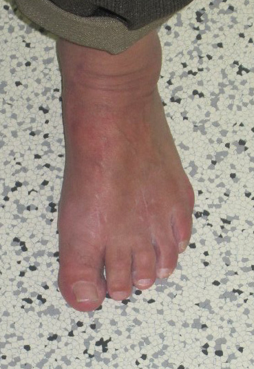Hallux Valgus Wuppertaler Fuss Initiative