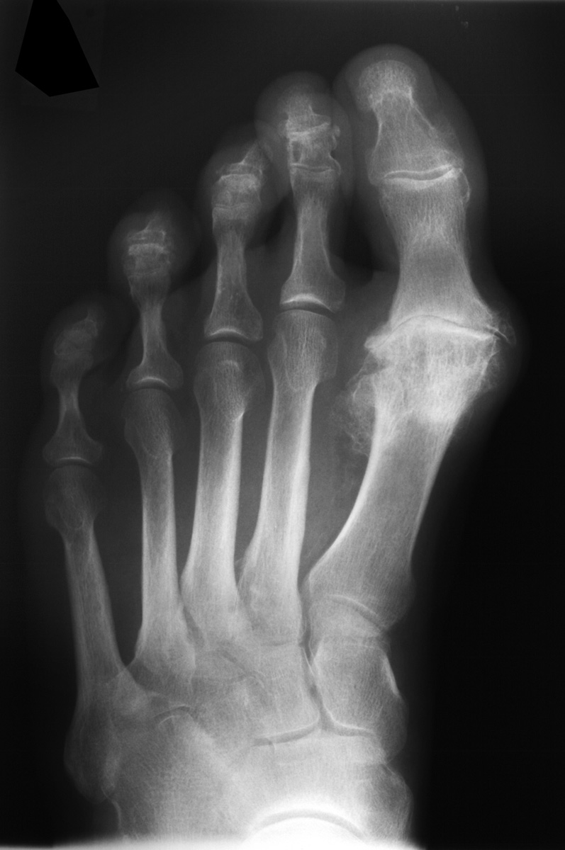 Fortgeschrittene Arthrose des Großzehengrundgelenks Fortgeschrittene Arthrose des Großzehengrundgelenks