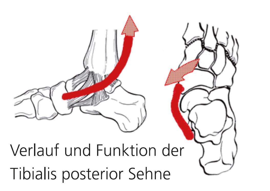 Der Plattfuß des Erwachsenen – Wuppertaler Fuß – Initiative