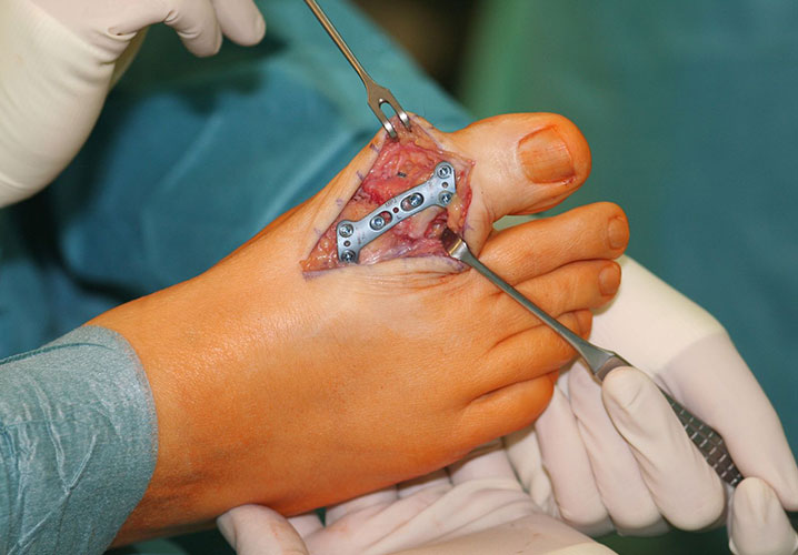 Arthrodese Großzehengrundgelenk Wuppertaler Fuß Initiative