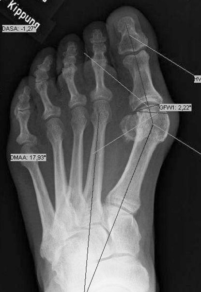 Röntgenbild schwere Hallux valgus Deformität Röntgenbild schwere Hallux valgus Deformität