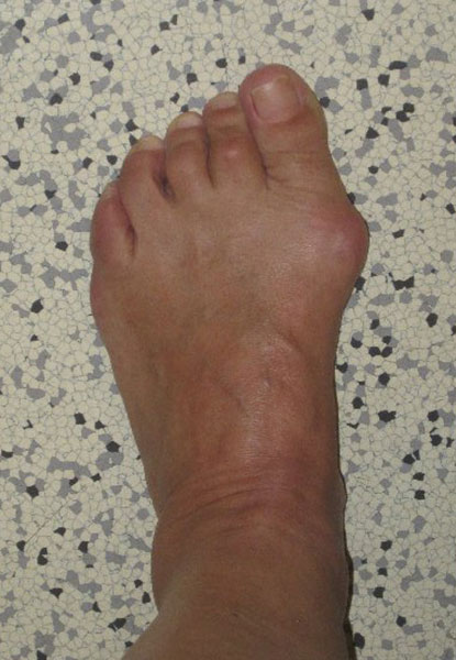 Schwere Hallux valgus Deformität Schwere Hallux valgus Deformität