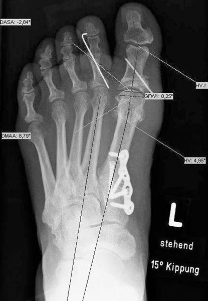 Röntgenbild nach Lapidus-Arthrodese mit einer plantaren Platte (Akin-Osteotomie der Großzehe) Röntgenbild nach Lapidus-Arthrodese mit einer plantaren Platte (Akin-Osteotomie der Großzehe)
