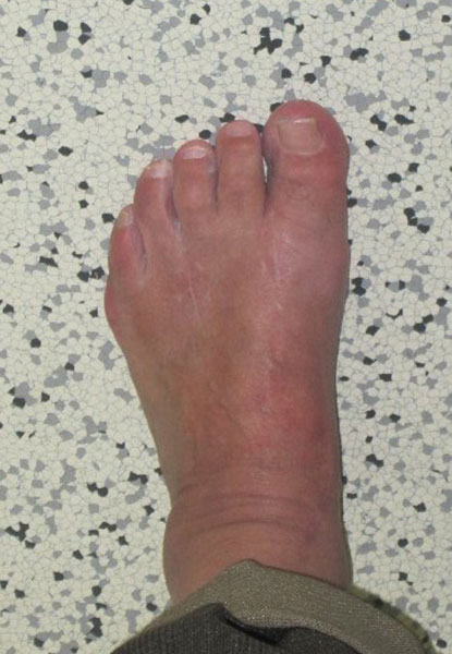 Klinisches Bild nach Lapidus-Arthrodese