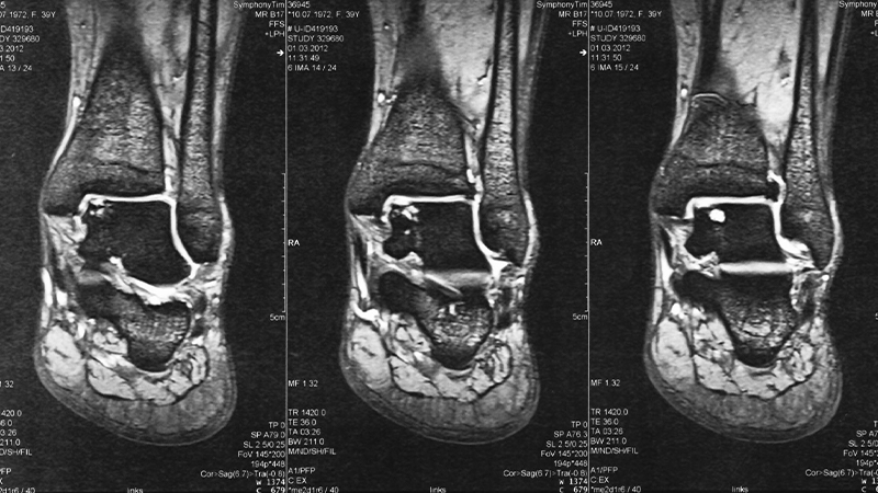 Osteochondrale Läsion – Wuppertaler Fuß – Initiative