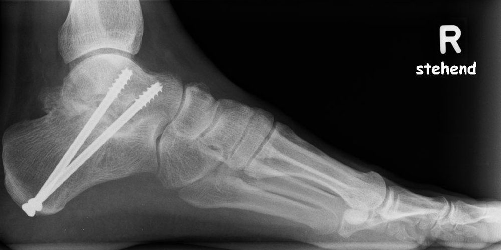 Arthrodese des unteren Sprunggelenks – Wuppertaler Fuß – Initiative