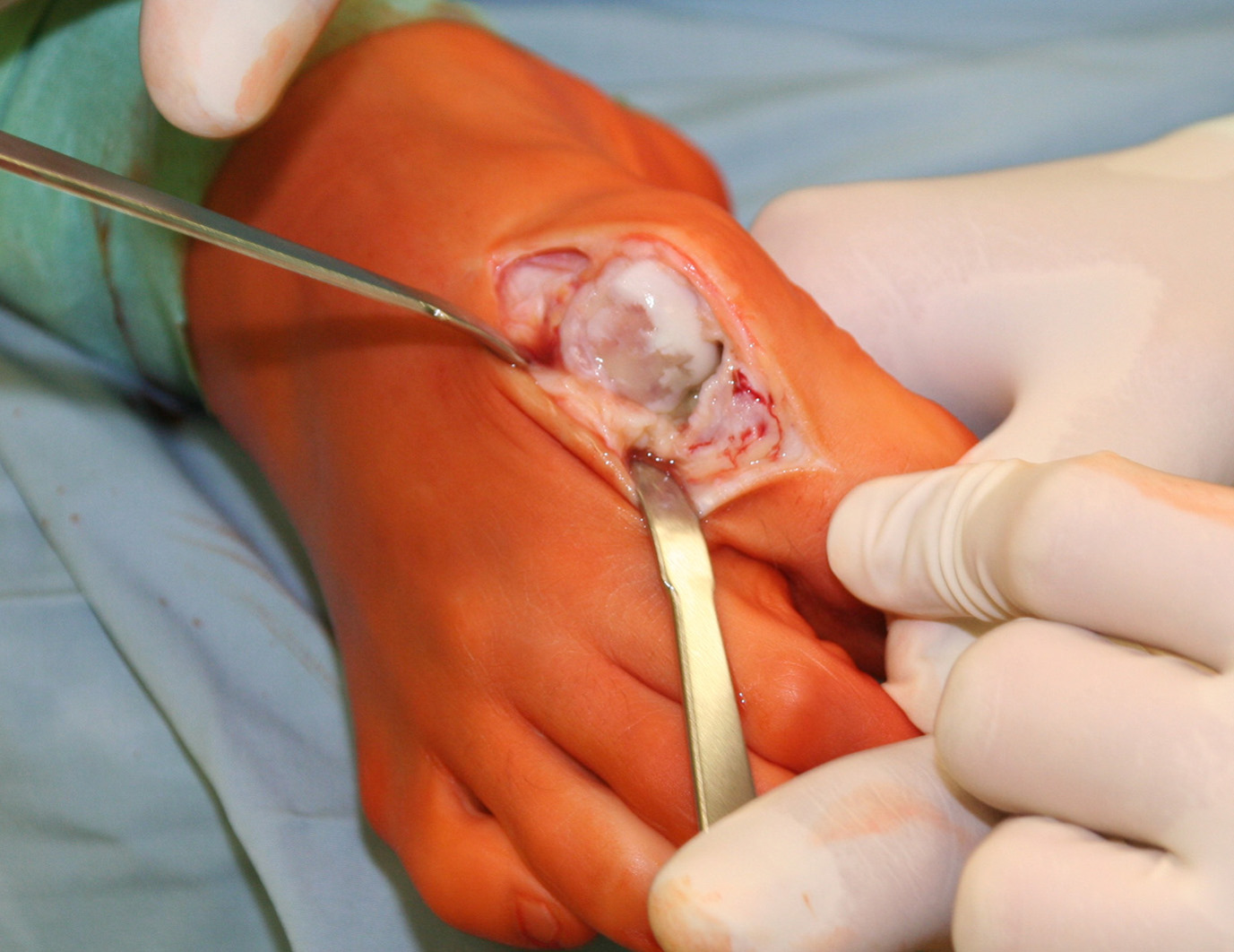 Intraoperatives Bild mit fortgeschrittenem Schaden des Gelenkknorpels Intraoperatives Bild mit fortgeschrittenem Schaden des Gelenkknorpels