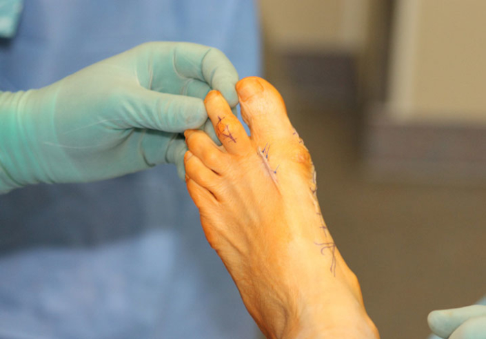 Hammerzehe-D2_Operative-Korrektur-des Hallux-bereits-erfolgt HammerzeheD2. Operative Korrektur des Hallux bereits erfolgt.