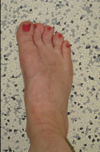 Klinisches-Bild-nach-Arthrodese-der-TMT-Gelenke-2-und-3