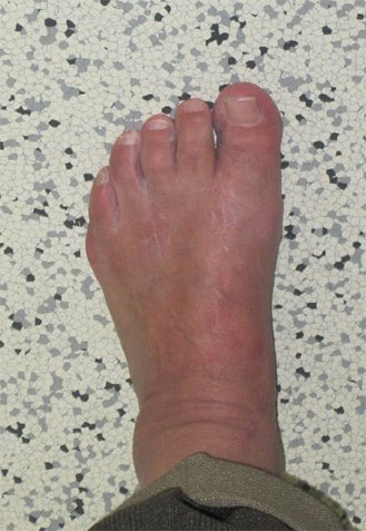 Klinisches Bild nach Lapidus-Arthrodese