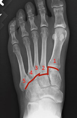 Lisfranc-Gelenklinie