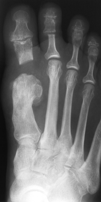 Weil-Osteo-03
