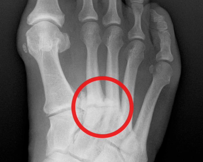 DoubleArthrodese Wuppertaler Fuß Initiative