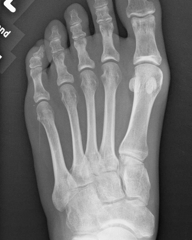 Lisfranc-Arthrodese – Wuppertaler Fuß – Initiative