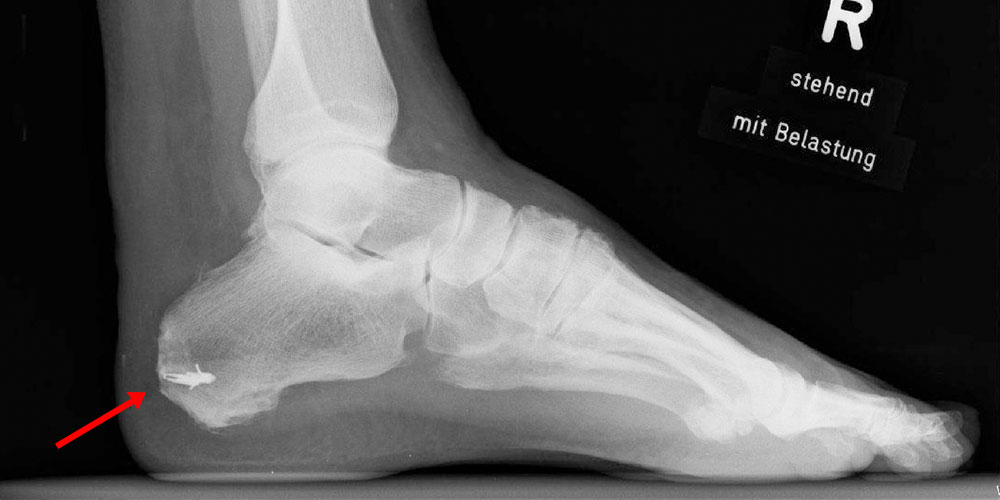 Fremdmaterial (Schrauben/Platten) Wuppertaler Fuß Initiative