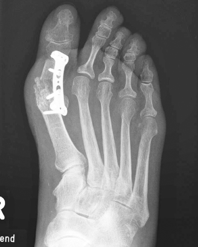 Fremdmaterial (Schrauben/Platten) Wuppertaler Fuß Initiative