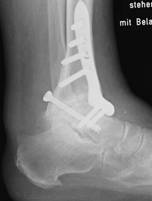OSG-Arthrodese