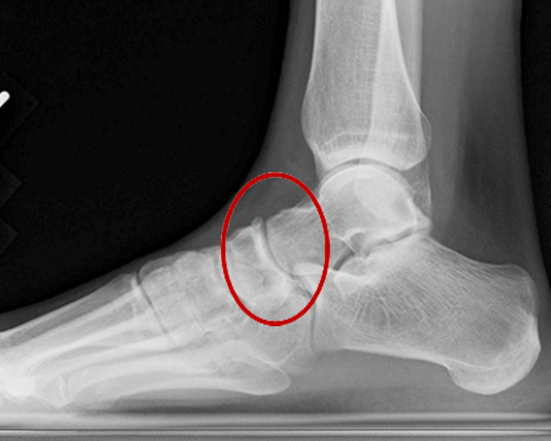 Talonavicular-Arthrodese – Wuppertaler Fuß – Initiative