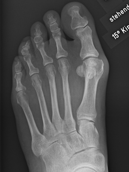 Hallux valgus – beidseitige Operation – Wuppertaler Fuß – Initiative